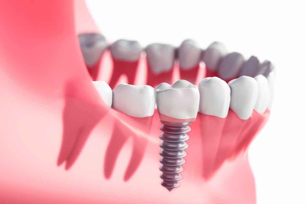rodzaje implantów zębowych i najważniejsze zalety
